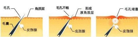 青春痘是怎么形成的原因