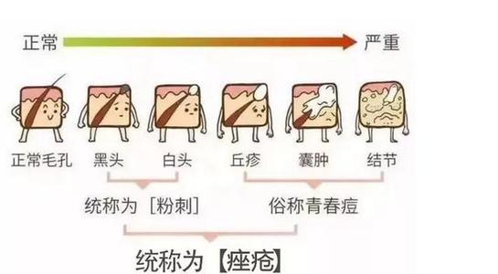 清痘痘的10个步骤 你值得注意！