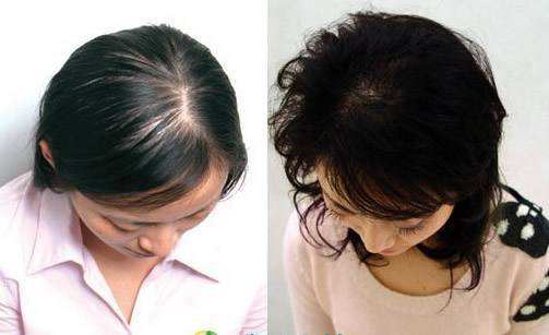      脱发期间会有哪些症状显现？