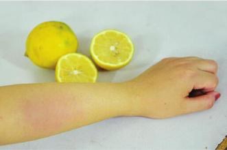 日光性皮炎表现症状是什么？