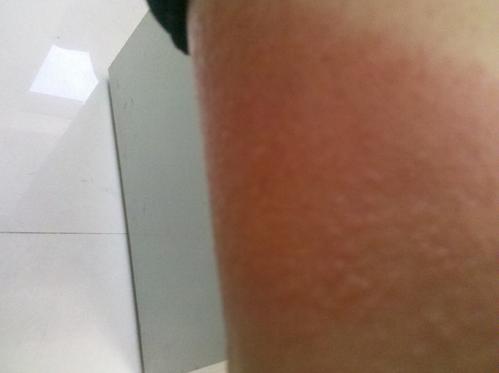 过敏性皮炎的病因有哪些