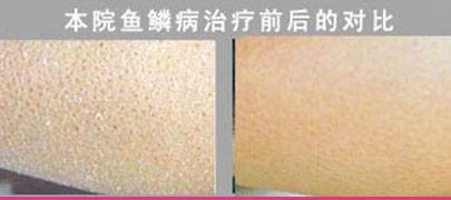      福州鱼鳞病治疗皮肤病医院